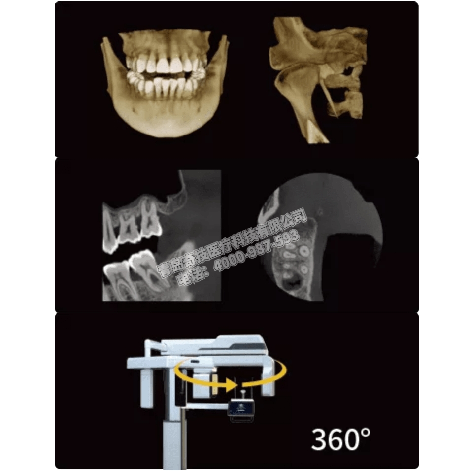 ǻCBCT ȫC(j)LARGEV(gu)a(chn)ҕa(chn)ƷB
